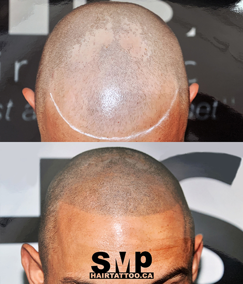 SMP® Scalp Micropigmentation Richmond Hill | HAIRTATTOO.CA | 9140 Leslie St #301, Richmond Hill, ON L4B 3L6, Canada | Phone: (647) 492-9093