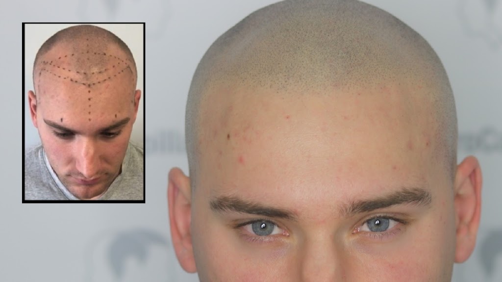 Clinique MicroCapillaire - Scalp Micropigmentation Capillaire | 2884 Chemin de Chambly, Longueuil, QC J4L 1G7, Canada | Phone: (450) 679-1888