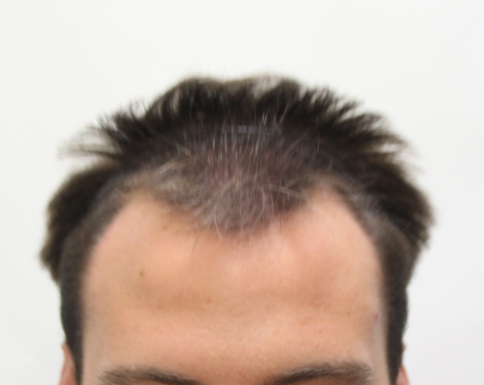 Rahal Hair Transplant Toronto | 1131 Leslie St #300, North York, ON M3C 3L8, Canada | Phone: (647) 559-2811