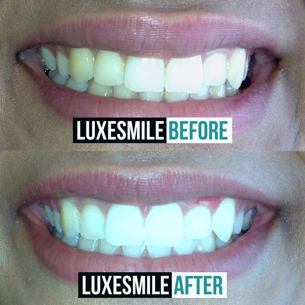 LuxeSmile | Teeth Whitening is all we do! | 3455 Fairview St, Burlington, ON L7N 2R4, Canada | Phone: (905) 469-6093