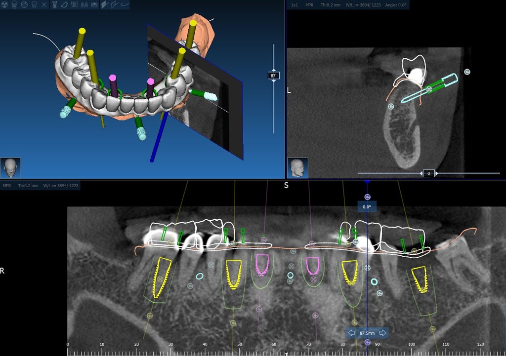 Advanced Implant Solutions | 6935 120 St #203, Delta, BC V4E 2A8, Canada | Phone: (604) 449-7626