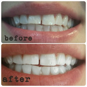 H-Smile Teeth Whitening and Dental Teeth Cleaning I Richmond Hil | 10376 Yonge St #202A, Richmond Hill, ON L4C 3B8, Canada | Phone: (905) 237-9333