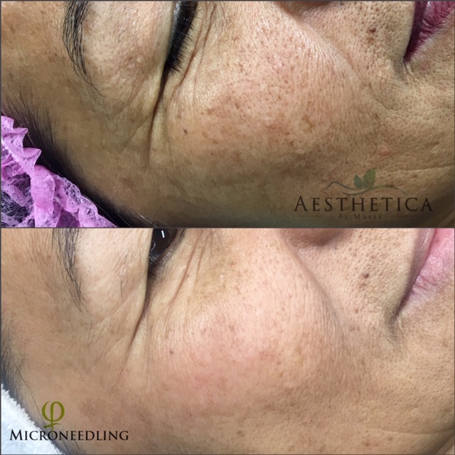 AESTHETICA MARIA / Phibrows Microblading and Medical Aesthetics  | 818 49 Ave SW, Calgary, AB T2S 1G9, Canada | Phone: (587) 434-7011