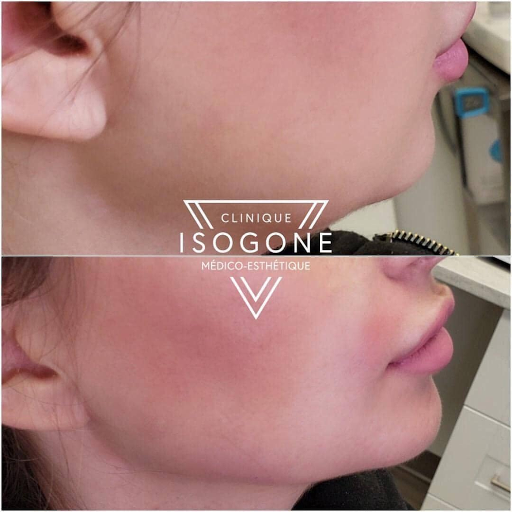 Clinique Isogone Médico-Esthétique | 1435 Boulevard Saint-Martin O Suite 502, Laval, QC H7S 2C6, Canada | Phone: (450) 667-6676