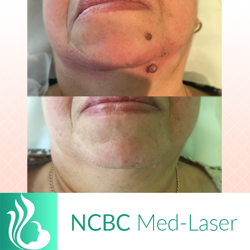 NCBC Med-Laser | 2090 Lawrence Ave E, Scarborough, ON M1R 2Z5, Canada | Phone: (416) 931-4772