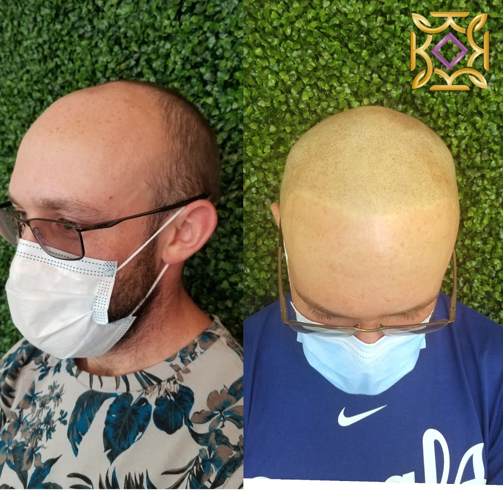 Karbena Scalp Micropigmentation | 22714 Dewdney Trunk Rd Suite 102, Maple Ridge, BC V2X 3K2, Canada | Phone: (778) 241-2433