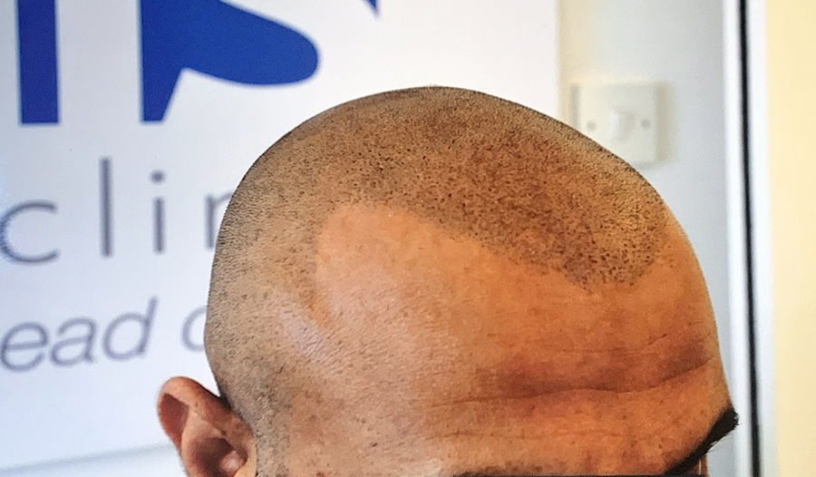 TRICHOLOGY CENTRE | Hair Loss and SMP Scalp Micropigmentation Ri | 9140 Leslie St Unit 301, Richmond Hill, ON L4B 3L6, Canada | Phone: (647) 492-9093