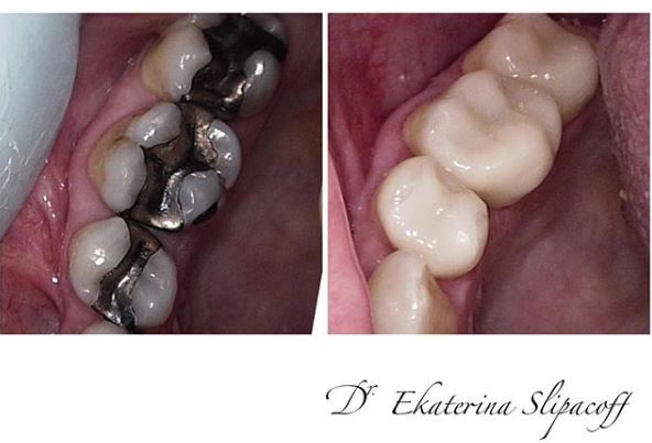 Slipacoff Dental Centre | 929 Michigan Ave, Sarnia, ON N7S 2A9, Canada | Phone: (519) 542-5658