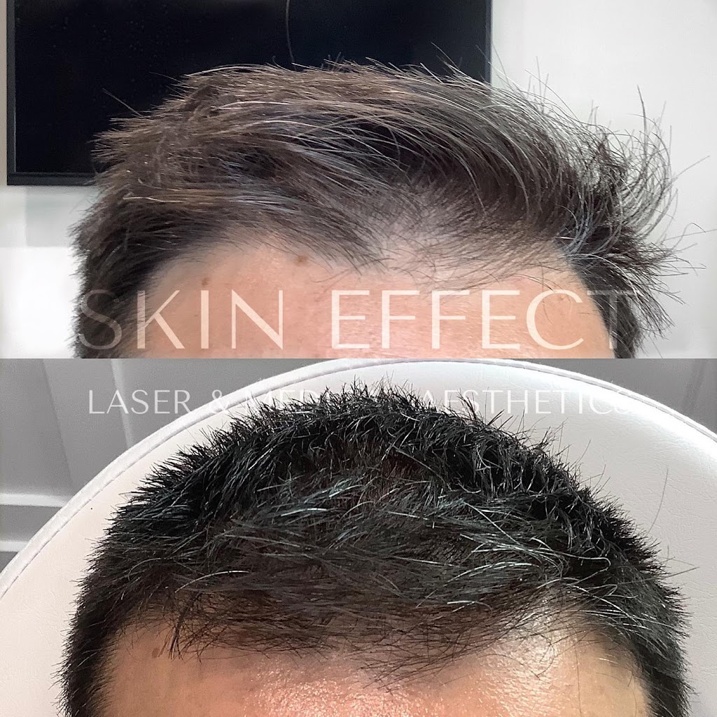 Skin Effect Laser and Medical Aesthetics | 10441 99 Ave Unit 701, Fort Saskatchewan, AB T8L 0V6, Canada | Phone: (780) 935-7546