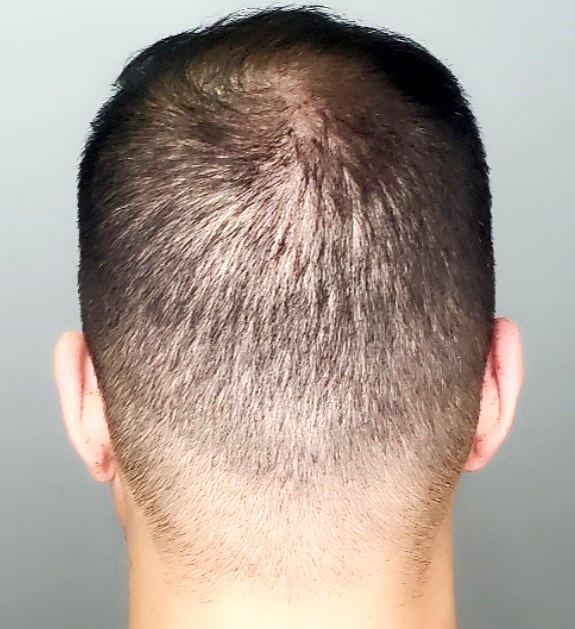 Scalp Micropigmentation by Chronic Ink - Markham | 7381 Kennedy Rd Unit #105, Markham, ON L3R 5B5, Canada | Phone: (905) 305-0311