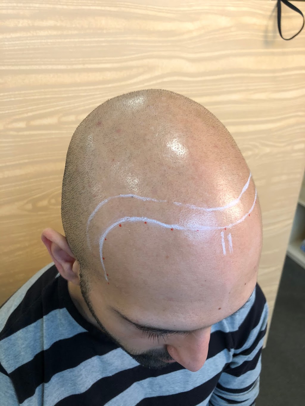 Kelowna Scalp Micropigmentation | 101-5305 Main St, Kelowna, BC V1W 4V3, Canada | Phone: (250) 462-6978