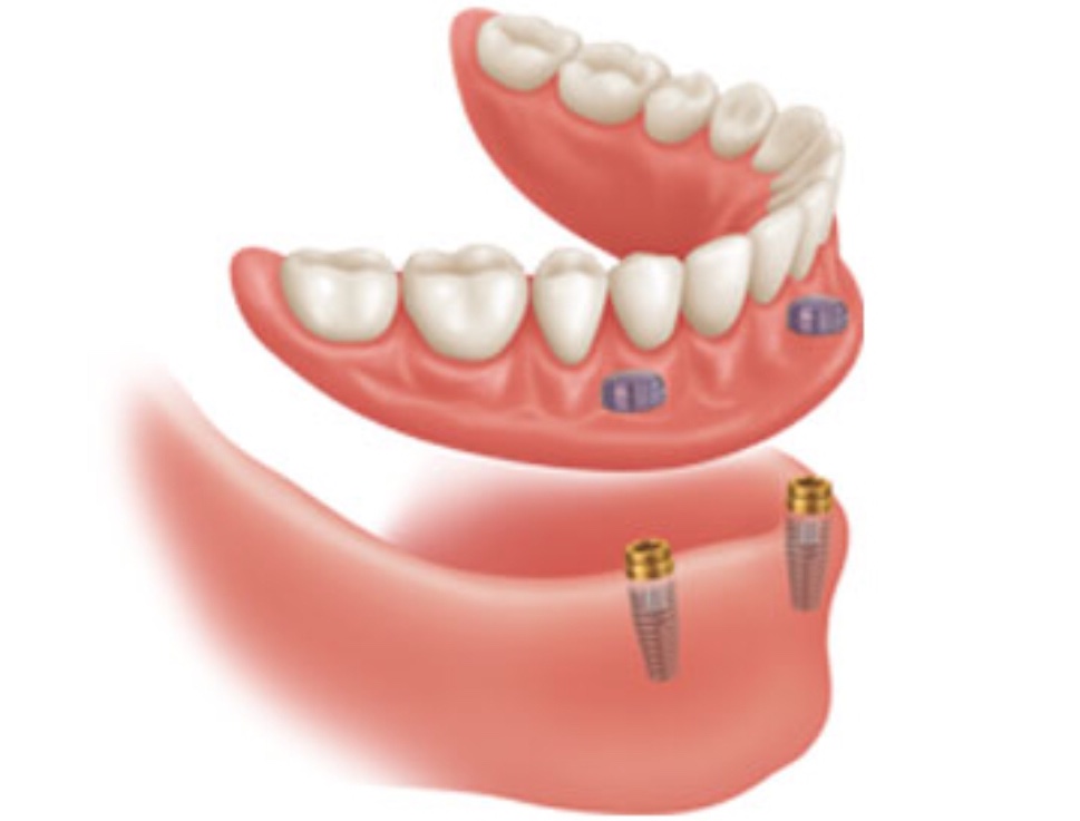 Cobourg Denture & Implant Design - Ron Reutcky, Denturist | 251 Division St, Cobourg, ON K9A 3P9, Canada | Phone: (905) 372-9839