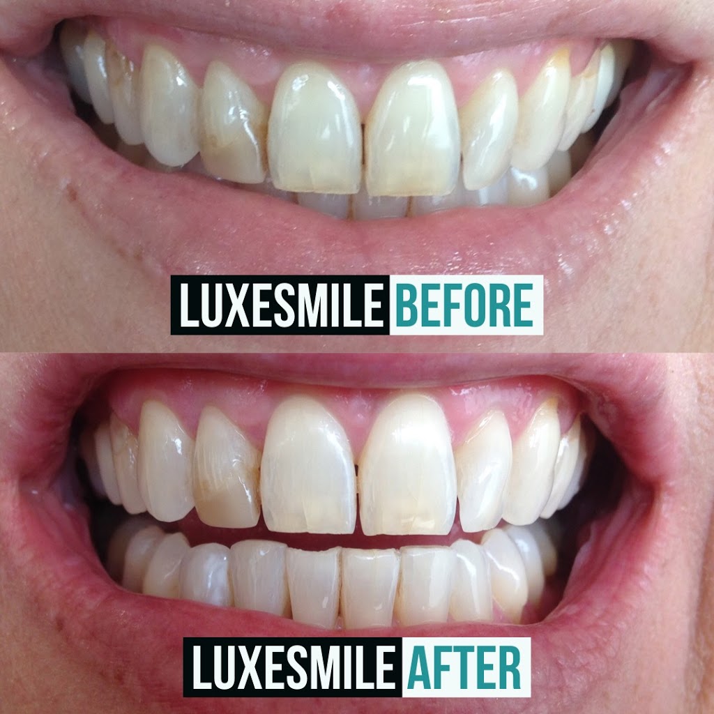 LuxeSmile | Teeth Whitening is all we do! | 22 Mill St S Unit 102, Waterdown, ON L0R 2H0, Canada | Phone: (905) 469-6093