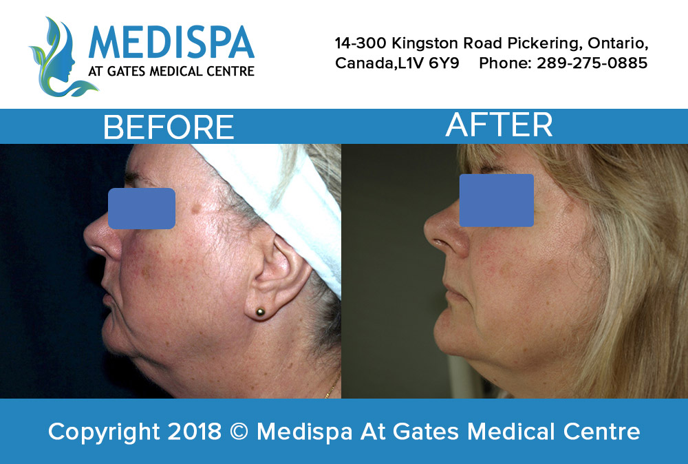 MediSpa At Gates Medical Centre | 14-300 Kingston Rd, Pickering, ON L1V 6Z9, Canada | Phone: (289) 275-0885