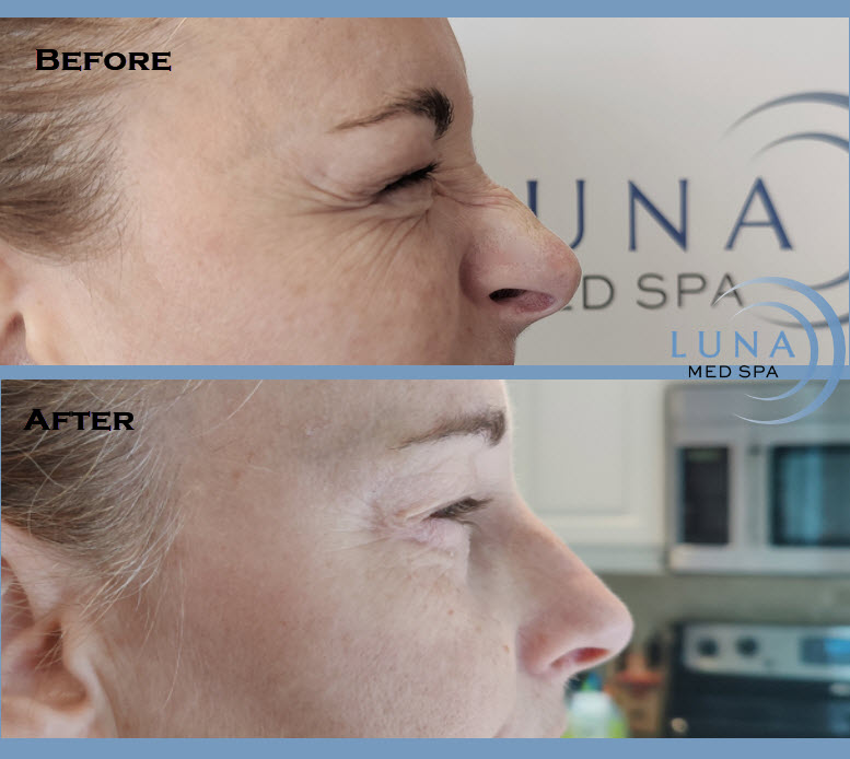 Luna Med Spa | RCI & MedSpa Group, 5045 Mainway Suite 201, Burlington, ON L7L 5Z1, Canada | Phone: (905) 981-8454