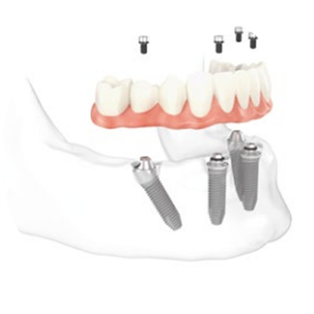 Expert Denture Clinic | 1050 Henderson Hwy #8, Winnipeg, MB R2K 2M5, Canada | Phone: (204) 334-0022