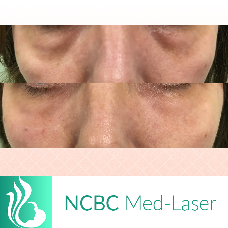 NCBC Med-Laser | 2090 Lawrence Ave E, Scarborough, ON M1R 2Z5, Canada | Phone: (416) 931-4772