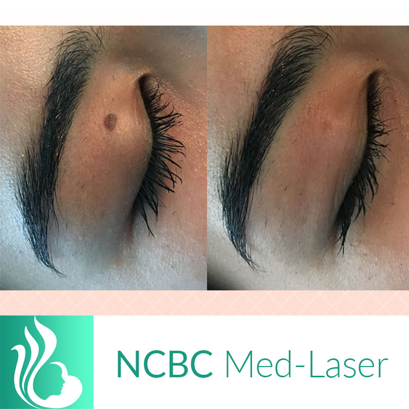 NCBC Med-Laser | 2090 Lawrence Ave E, Scarborough, ON M1R 2Z5, Canada | Phone: (416) 931-4772