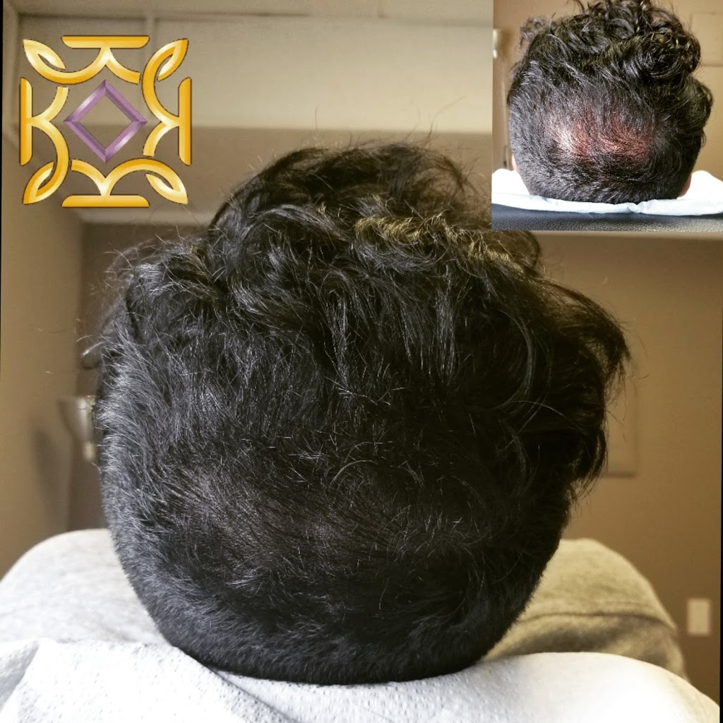 Karbena Scalp Micropigmentation | 22714 Dewdney Trunk Rd Suite 102, Maple Ridge, BC V2X 3K2, Canada | Phone: (778) 241-2433