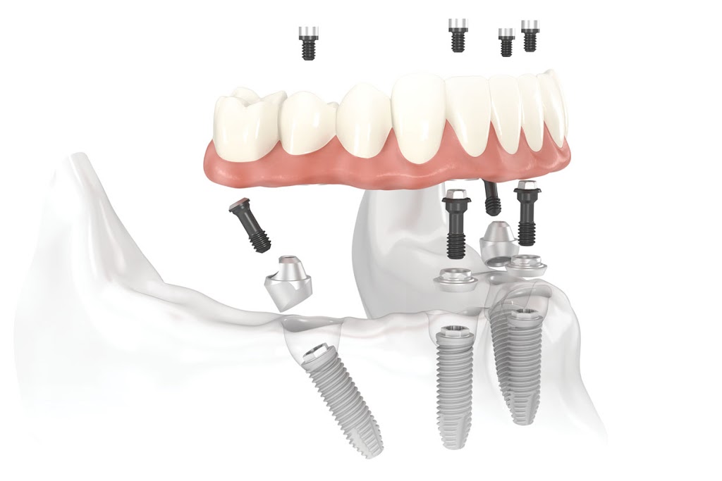 St. Albert Denture and Implant Clinic | 516 St Albert Trail #10, St. Albert, AB T8N 5Z1, Canada | Phone: (780) 459-3437