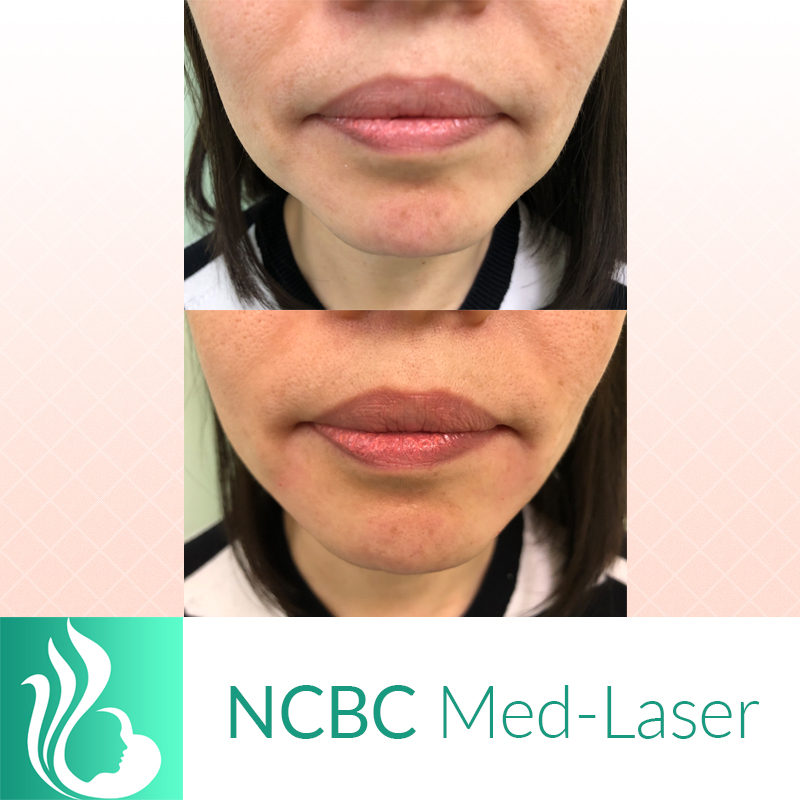 NCBC Med-Laser | 2090 Lawrence Ave E, Scarborough, ON M1R 2Z5, Canada | Phone: (416) 931-4772