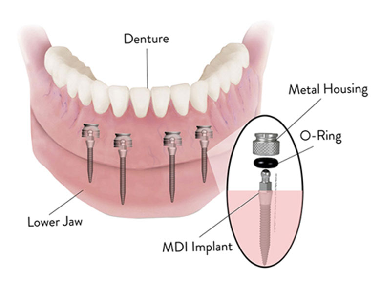 Dental Implant Solutions of Eden, NY | 2763 W Church St #1, Eden, NY 14057, USA | Phone: (716) 226-0806