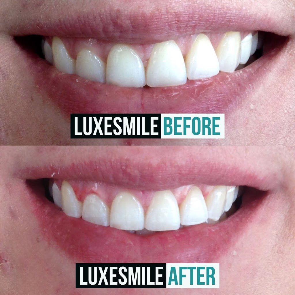 LuxeSmile | Teeth Whitening is all we do! | 3455 Fairview St, Burlington, ON L7N 2R4, Canada | Phone: (905) 469-6093