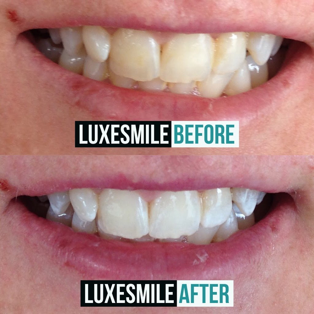 LuxeSmile | Teeth Whitening is all we do! | 22 Mill St S Unit 102, Waterdown, ON L0R 2H0, Canada | Phone: (905) 469-6093