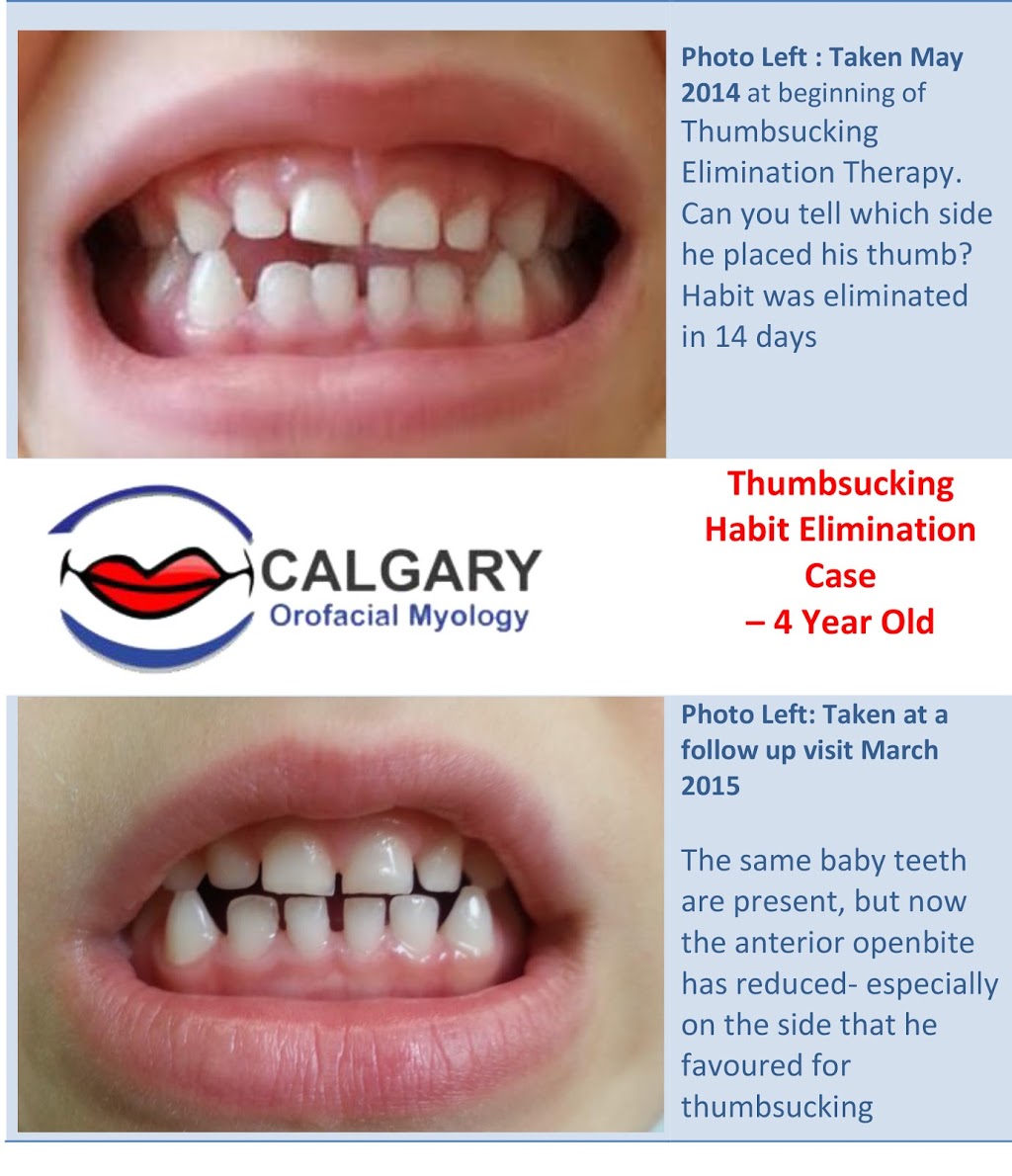 Calgary Orofacial Myology | c/o Shawn Ryer Lifetime Smiles Dental Hygiene Clinic Suite 204,, 11150 Bonaventure Dr SE, Calgary, AB T2J 6R9, Canada | Phone: (403) 457-2044