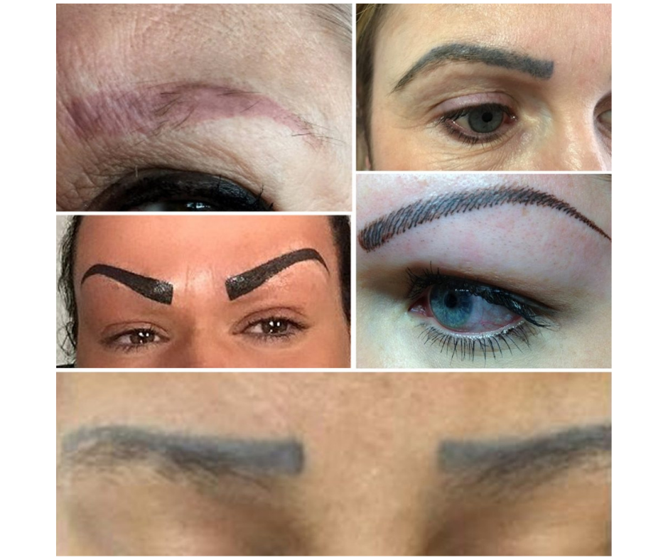 Emergency Removal - Eyebrow Tattoo Removal | 11675 Seventh Ave, Richmond, BC V7E 4X4, Canada | Phone: (672) 514-1790