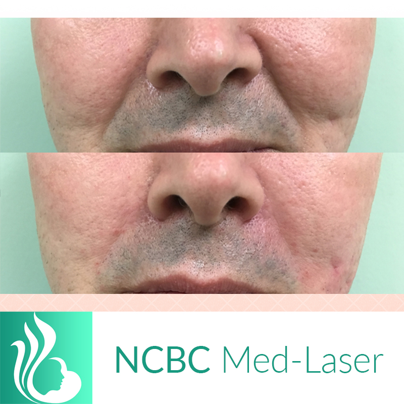 NCBC Med-Laser | 2090 Lawrence Ave E, Scarborough, ON M1R 2Z5, Canada | Phone: (416) 931-4772