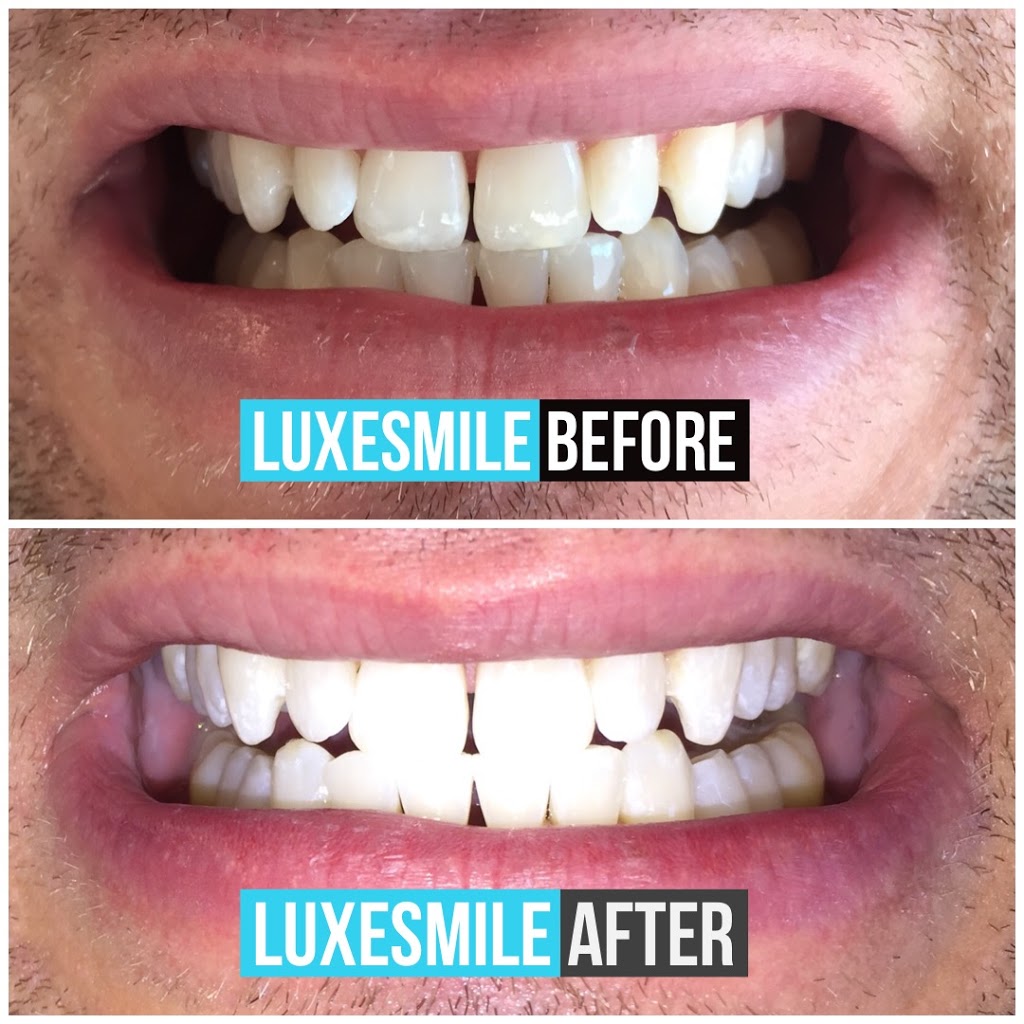 LuxeSmile | Teeth Whitening is all we do! | 22 Mill St S Unit 102, Waterdown, ON L0R 2H0, Canada | Phone: (905) 469-6093