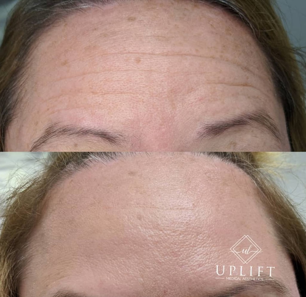 Uplift Medical Aesthetics | 2022 Main St N, Jarvis, ON N0A 1J0, Canada | Phone: (519) 420-9225