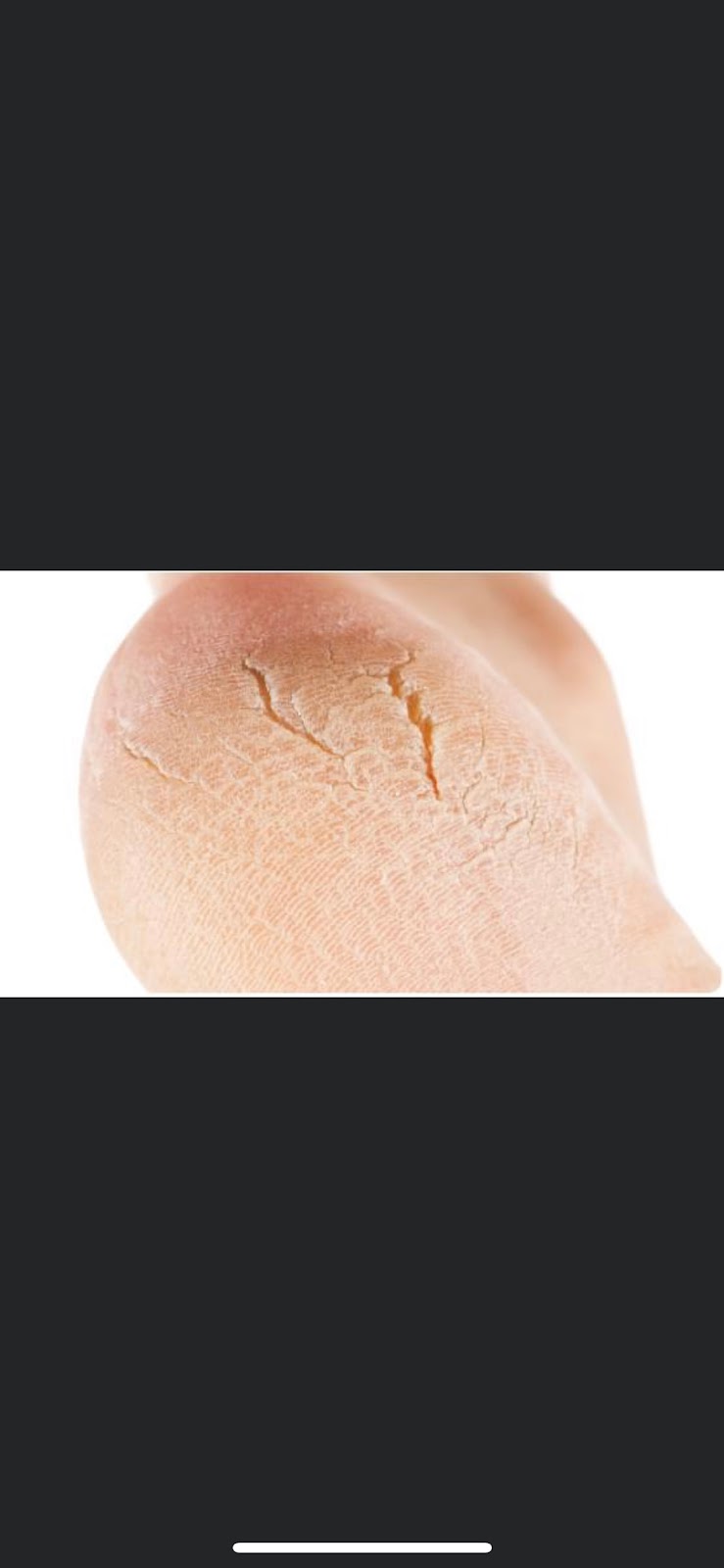 Clinique de soins de pieds/soins infirmiers Beauport | 202 Avenue St Michel, Québec, QC G1C 1G1, Canada | Phone: (418) 265-9447