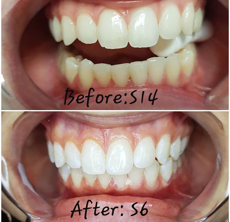 Ottawa Teeth Whitening | 2742 St Joseph Blvd #10, Orléans, ON K1C 1G5, Canada | Phone: (613) 808-9344