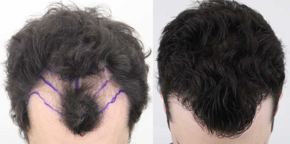 Rahal Hair Transplant Toronto | 1131 Leslie St #300, North York, ON M3C 3L8, Canada | Phone: (647) 559-2811