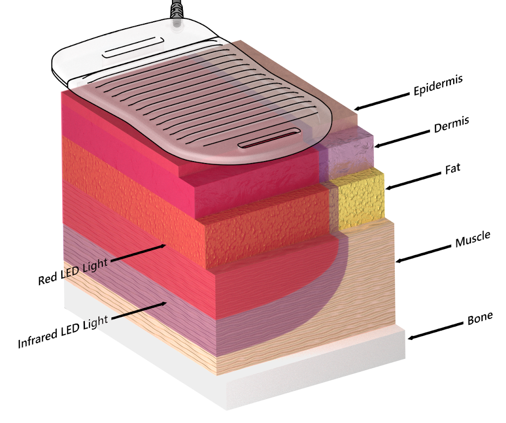 Dr. Phils BioFlex Cold Laser | 1066 Brant St, Burlington, ON L7R 2J9, Canada | Phone: (905) 634-8598